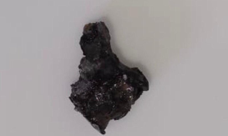 סמוטריץ׳ חושף: הרסיס שפצע את בנו: ״בצורת ארץ ישראל״