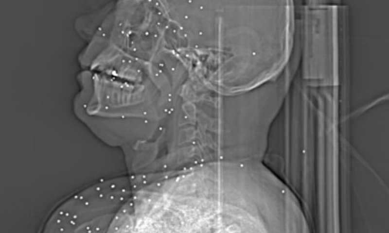 הזוועה באיראן נחשפת: צילומים רפואיים מוכיחים את טבח המפגינים