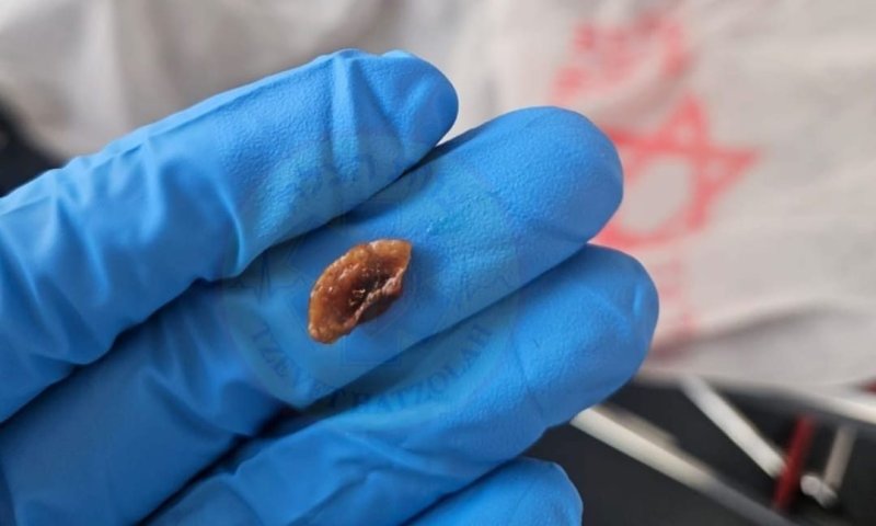 כמעט אסון: פעוט נחנק כי אכל אגוז לכבוד ט"ו בשבט &ndash; וניצל