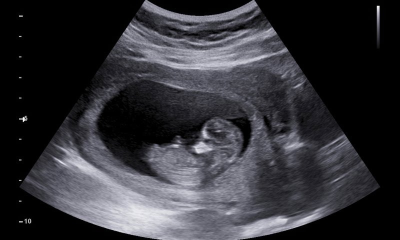 אסותא: "נבקש מביהמ"ש אישור לבדיקות גנטיות"