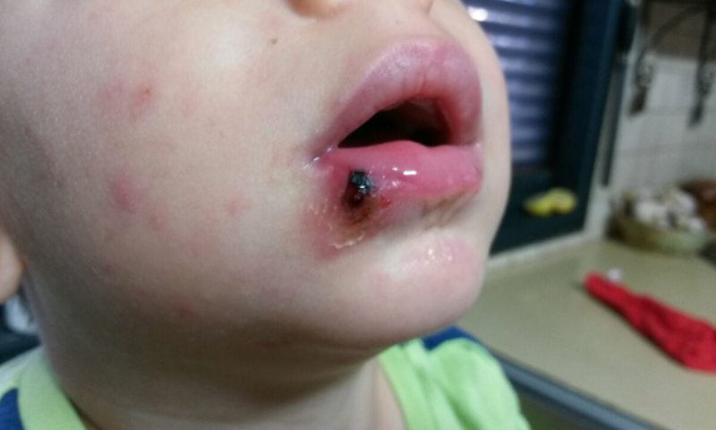 ליצמן יוצא למלחמה במגפת הלישמניה ביו"ש