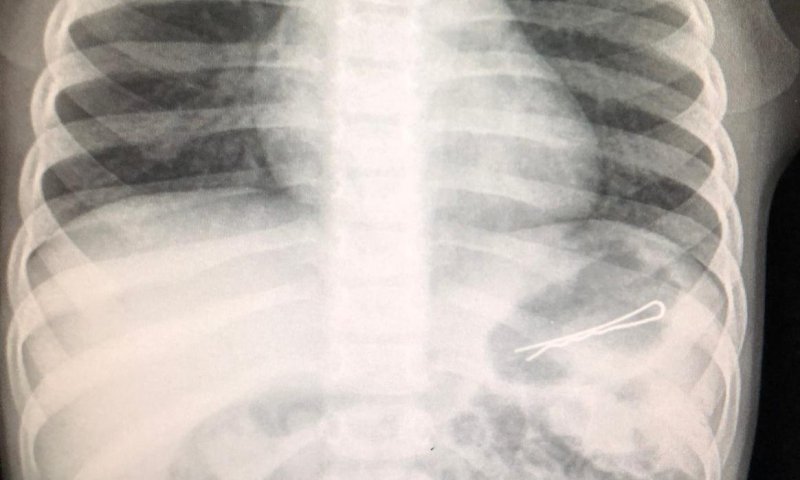 בן 3 ניצל כשמגופו נשלפה סיכה באורך 6 ס"מ