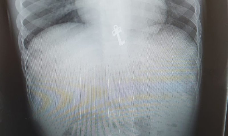 לאחר צילום רנטגן התגלה: בן ה-7 בלע מפתח | תיעוד