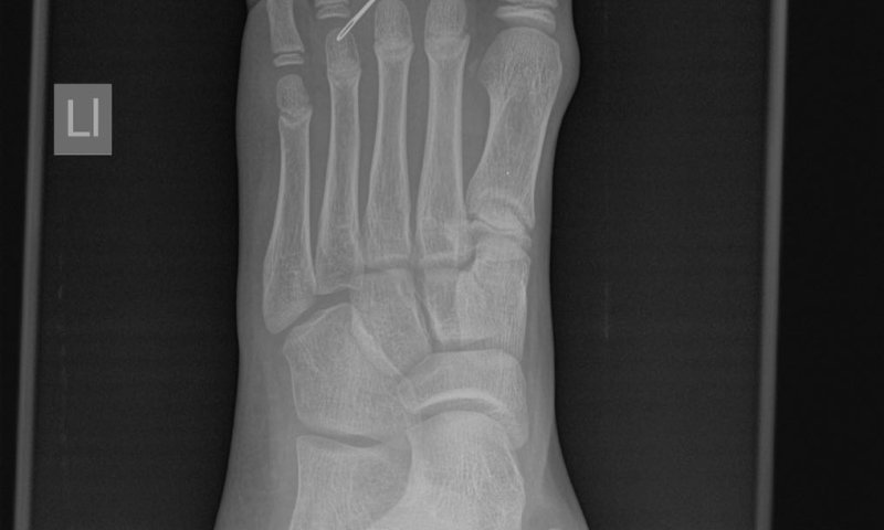 המחט חדרה לכף הרגל של הילד ונשברה