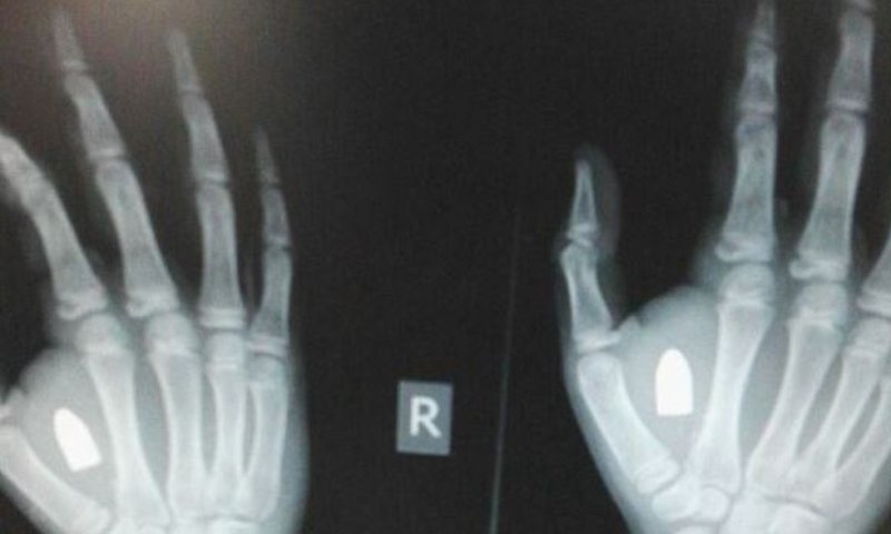 הזוי: ילד התלונן על נפיחות, הרופאים מצאו ביד קליע