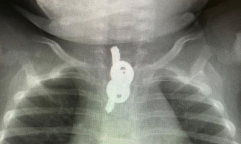 ההורים פנו עם בנם למיון ומצאו "הפתעה" בבטנו