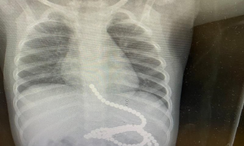 ניצל בנס: פעוט בלע 50 מגנטים, הרופאים הצילו את חייו