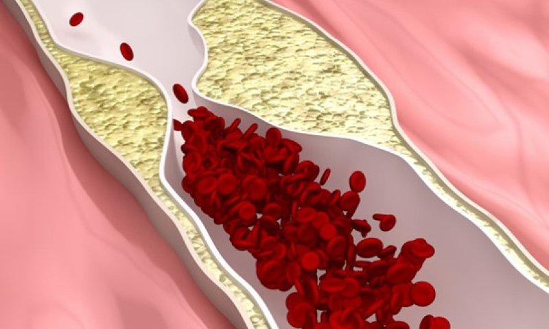הקשר בין כולסטרול גבוה וראייה