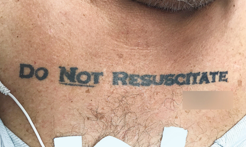 הלם: בעקבות קעקוע- רופאים נתנו לחולה למות