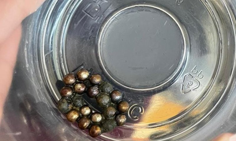 בן 8 בלע 20 מגנטים ועבר ניתוח להוצאתם מגופו