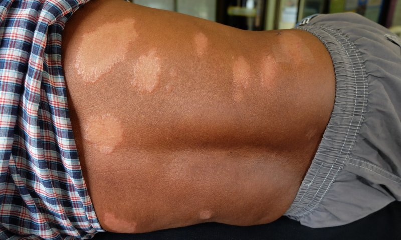 קצר על הפרשה | דיני צרעת ועולמנו הדתי והמוסרי &bull; צפו: