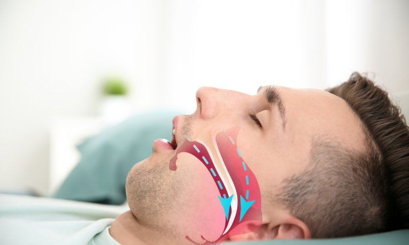 לא מדע בדיוני: הלייזר שיעזור לכם להפסיק לנחור