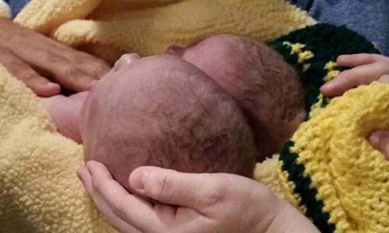 הודו: אישה ילדה תינוק בעל שני ראשים. צפו