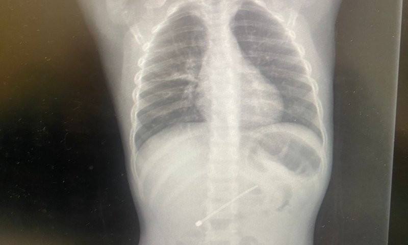 ילד בן 5 מהצפון בלע אנטנה באורך 7.5 ס"מ