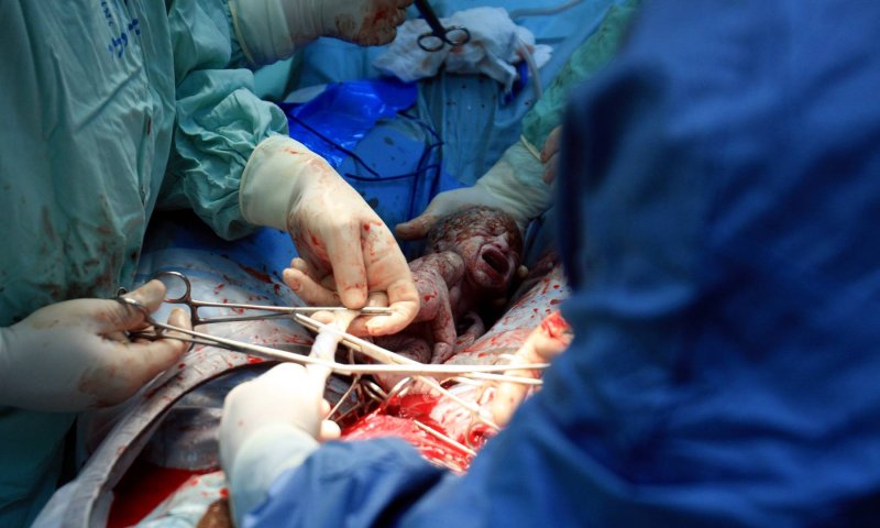 מעייני הישועה: ניתוח קיסרי מספר 10 לאישה אחת