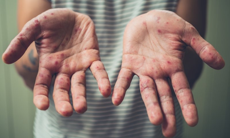 החצבת ממשיכה לגבות קורבנות: פעוט בן שנה וחצי נפטר בירושלים