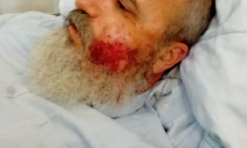 "ניסיון לרצח": עמנואל שילה נפצע בפיגוע אבנים