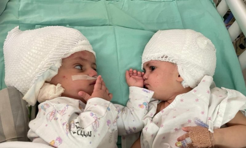 לראשונה בישראל, תאומות סיאמיות הופרדו בניתוח מורכב