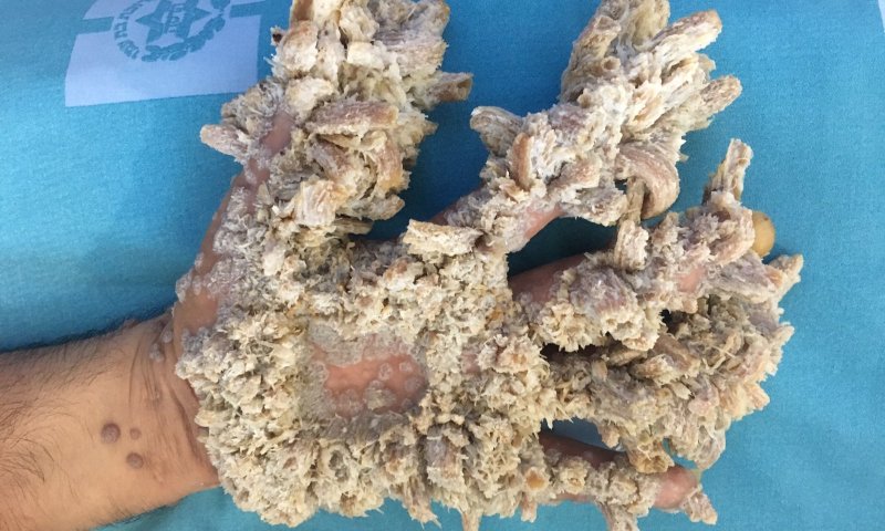 הרופאים בהדסה הצילו את ידו של "איש העץ"