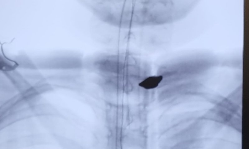 נס: רסיס של 18 מ"מ הוצא מגופו של ילד ממג'דל שמס