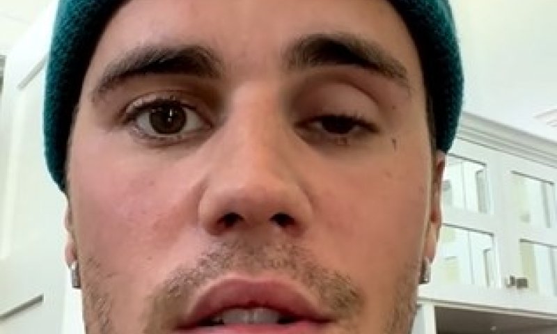 ג'סטין ביבר חושף כי חצי מפניו משותקות